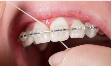 牙齒矯正者更要使用！居家口腔護理專欄-牙線篇-矯正者如何使用牙線？