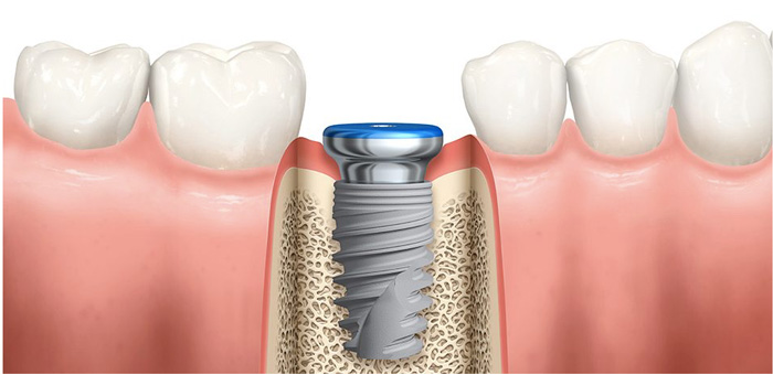 專科植牙技術示意圖—WECARE．康世維如何締造超高植牙成功率？四大核心一看就懂！