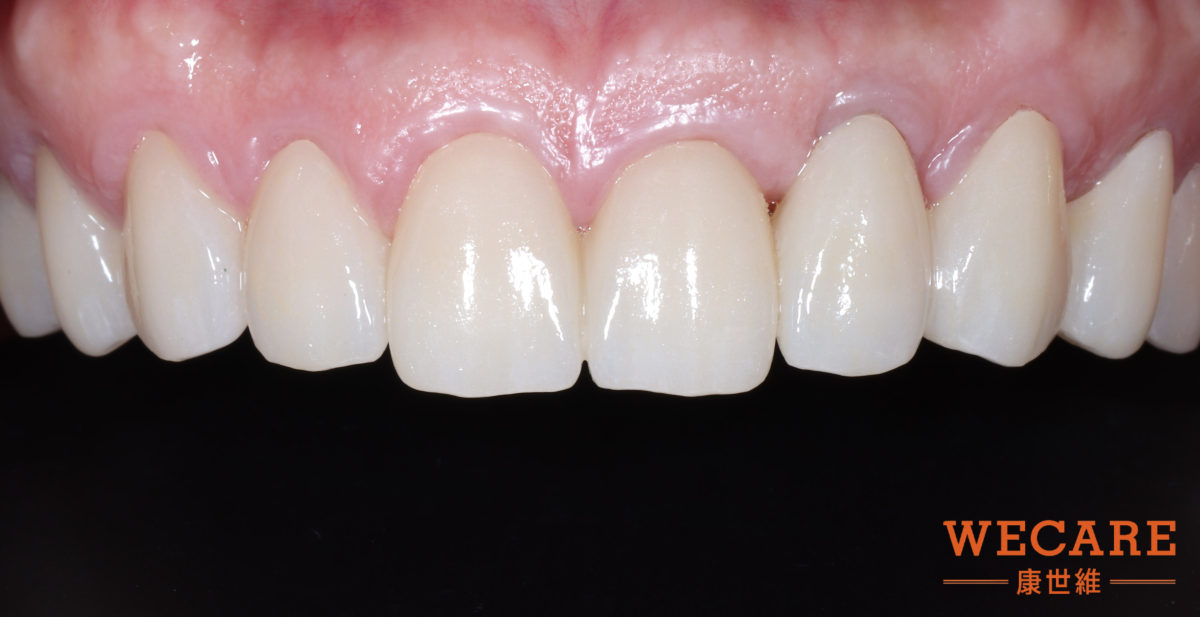 after Periodontal disease